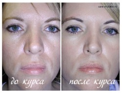 Фото до и после проведения курса